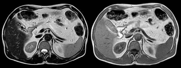 Complete lipomatous conversion of the pancreas