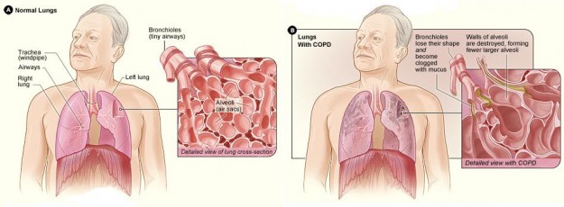 COPD COPD