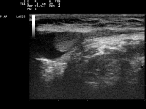 Cryptorchidism, undescended testis Cryptorchidism, undescended testis