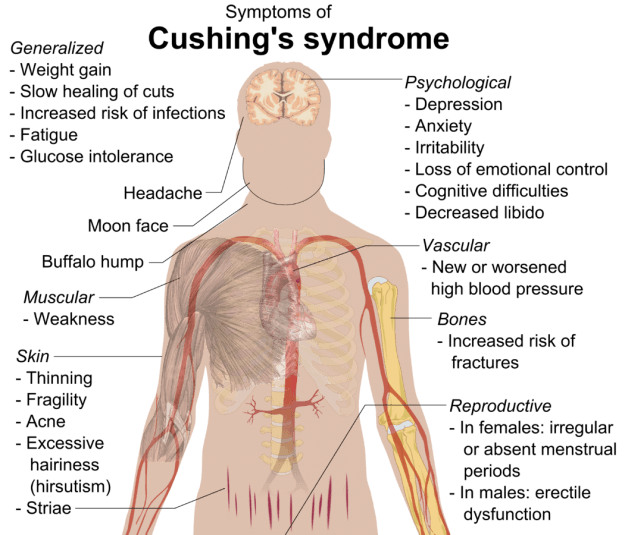 Cushing's syndrome