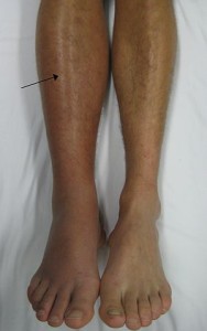 Deep vein thrombosis of the right leg