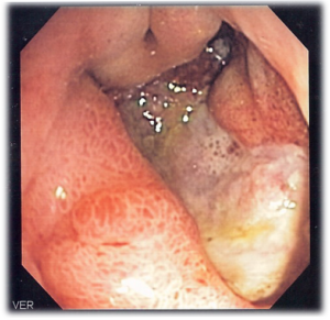deep gastric ulcer