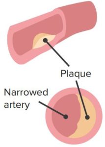 Peripheral arterial disease