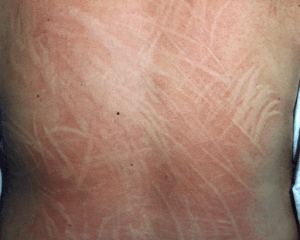Dermographic urticaria resulting from pressure through clothing Dermographic urticaria resulting from pressure through clothing