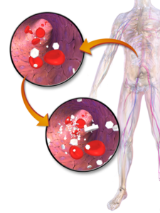 Diabetes and High Blood Sugar