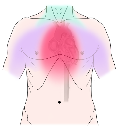 Diagram of discomfort caused by coronary artery disease