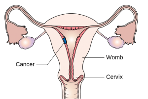 Diagram showing stage 1 choriocarcinoma Diagram showing stage 1 choriocarcinoma