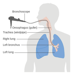 diagram showing a bronchoscopy