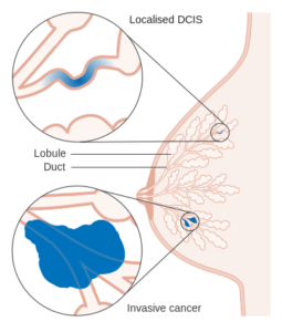 diagram showing ductal carcinoma in situ