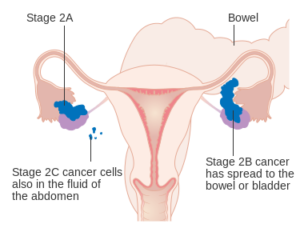 diagram showing stage 2 ovarian cancer