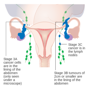 diagram showing stage 3 ovarian cancer