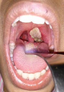 Dirty white pseudomembrane classically seen in diphtheria