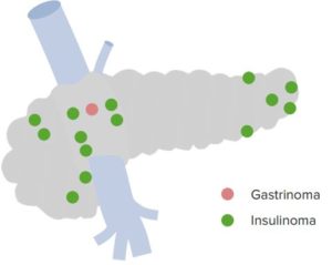 Distribution of Functioning Neuroendocrine Tumors of Pancreas