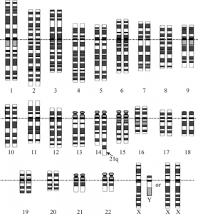 Down Syndrome translocation Down Syndrome translocation