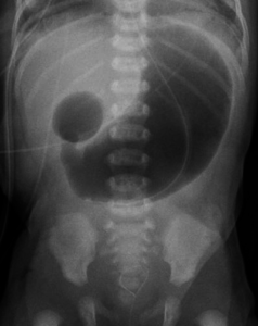duodenal atresia