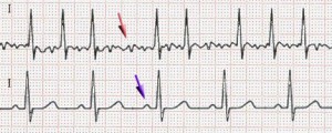 ECG of atrial fibrillation (top) and normal sinus rhythm (bottom).