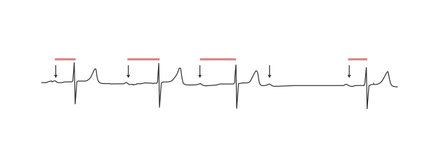 EKG2 EKG2