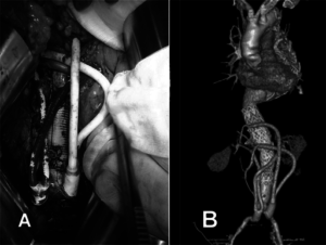 Endovascular aneurysm repair