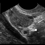 Ectopic pregnancy ultrasound