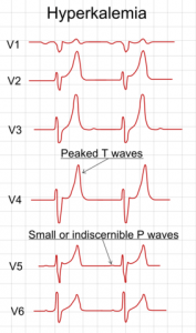 Electrocardiography showing precordial leads in hyperkalemia Electrocardiography showing precordial leads in hyperkalemia
