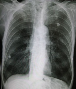 Emphysema Emphysema