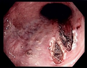 Endoscopic image of Mallory-Weiss tear Endoscopic image of Mallory-Weiss tear