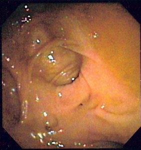 Endoscopic image of diverticulosis Endoscopic image of diverticulosis