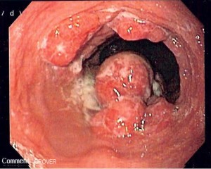 Endoscopic image of patient with esophageal adenocarcinoma seen at gastro-esophageal junction