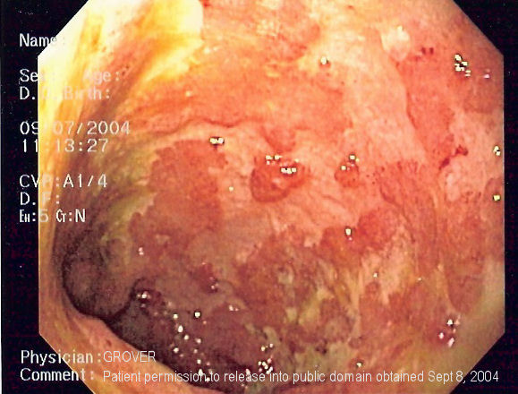 Endoscopic image of ulcerative colitis