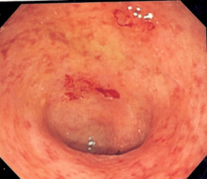 Endoscopic image of ulcerative colitis