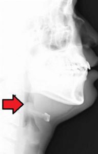 epiglottitis x-ray