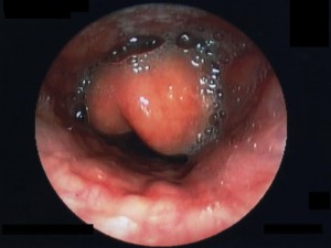 Image: "Epiglottitis endoscopy". License: CC BY-SA 3.0