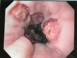 Esophageal varices