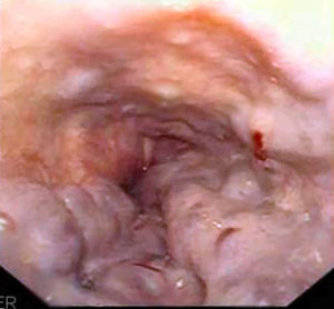 Esophageal varices