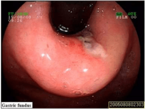 Esophagogastroduodenoscopy revealed Mallory-Weiss syndrome Esophagogastroduodenoscopy revealed Mallory-Weiss syndrome