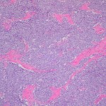 Histopathological Image of Ewing Sarcoma Histopathological Image of Ewing Sarcoma