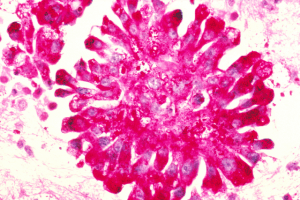 Ewing sarcoma cells Ewing sarcoma cells