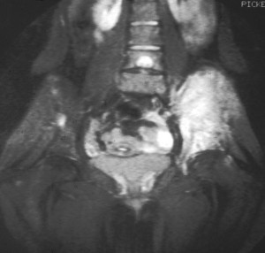 MRI showing Ewing's sarcoma of the left hip MRI showing Ewing's sarcoma of the left hip