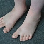 Feet of a 10 year old boy with Down Syndrome, with the typical large space between the large toe and second toe Feet of a 10 year old boy with Down Syndrome, with the typical large space between the large toe and second toe