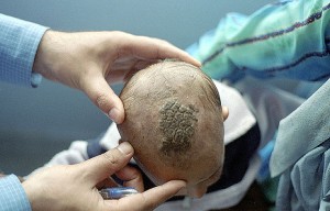 An infant with favus in India