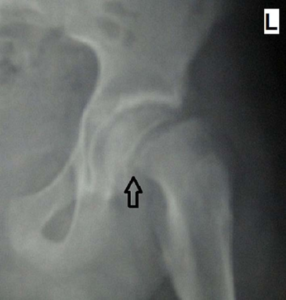 Frog-leg-orthopedic-leg-problems