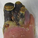 Gangrene of the 1st to 4th toes of the right foot in person with diabetes Gangrene of the 1st to 4th toes of the right foot in person with diabetes