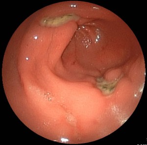 Gastric Ulcer Antrum