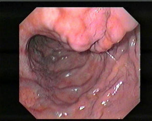 Gastric varices