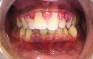 Image: "Gingivahyerplasia" by Lesion. Licence: CC BY-SA 3.0