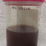 Gross hematuria due to kidney trauma Gross hematuria due to kidney trauma