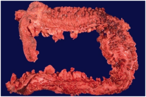Gross photograph of ulcerative colitis
