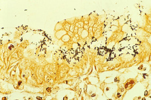 H. pylori colonized on the surface of regenerative epithelium