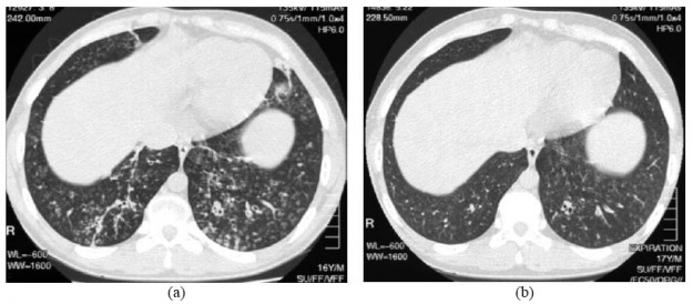 HRCT scans of diffuse panbronchiolitis HRCT scans of diffuse panbronchiolitis