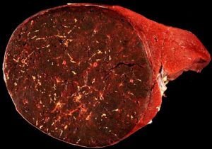Hamartoma-of-the-spleen